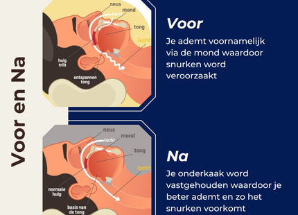 STEGGER - anti snurk beugel - Mondstuk voor het slapen - Anti Snurk - Snurkbeugel - MBDeals.nl